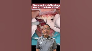 Dental Composite Bridge to Replace Missing Front Tooth | View Mobile Dental #shorts
