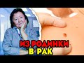 Как диагностировать возможность перехода родинки в рак?