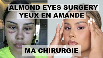 Comment étirer ses yeux chirurgie ?