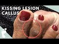 How to Get Rid of a Kissing Lesion Callus