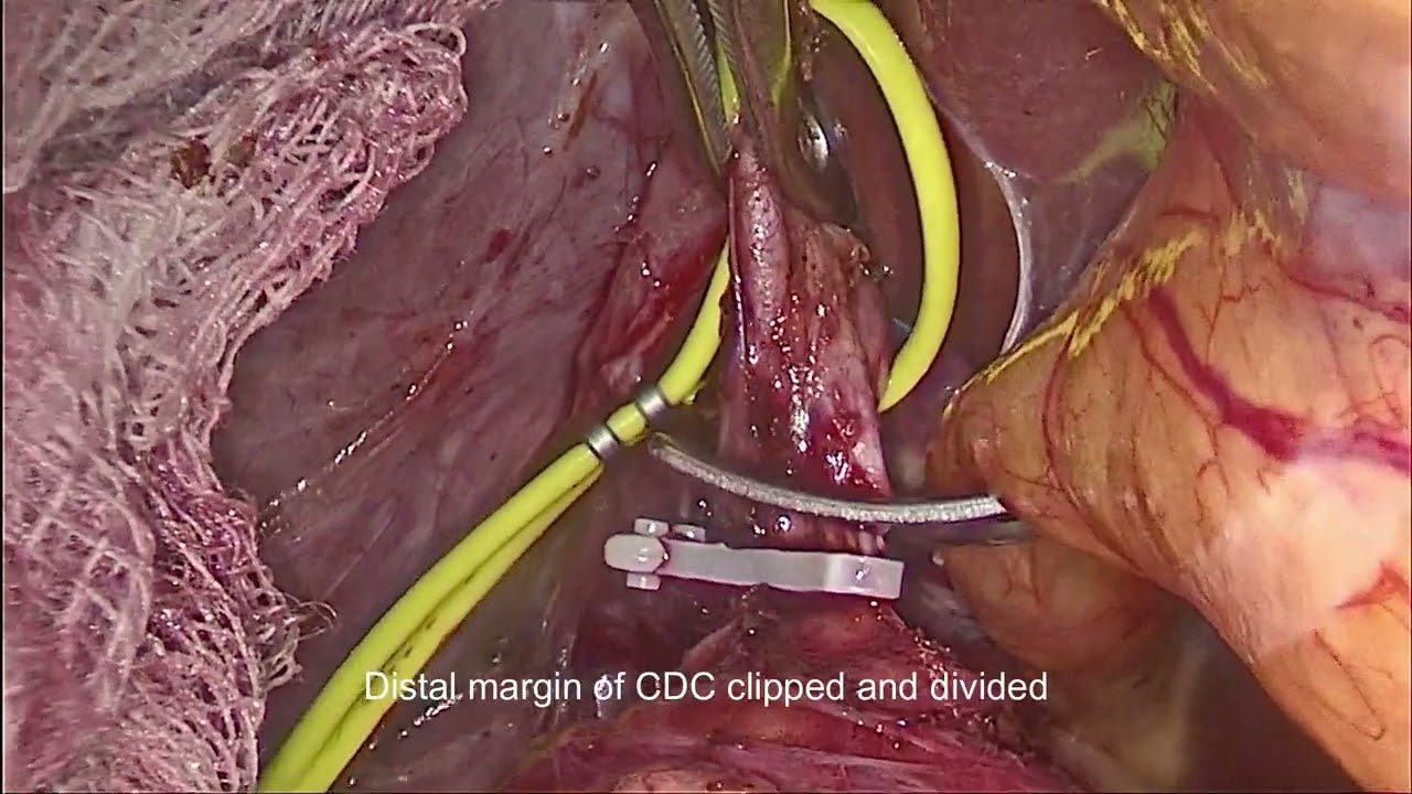 Laparoscopic Choledochal cyst excision with RYHJ