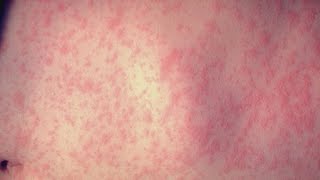 Health officials issue warning after measles outbreak in West Texas