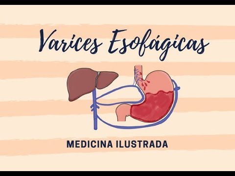 Varices Esofágicas + Anatomía Venas Estómago