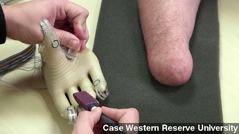 New Prosthetic Technology Helps Patients 