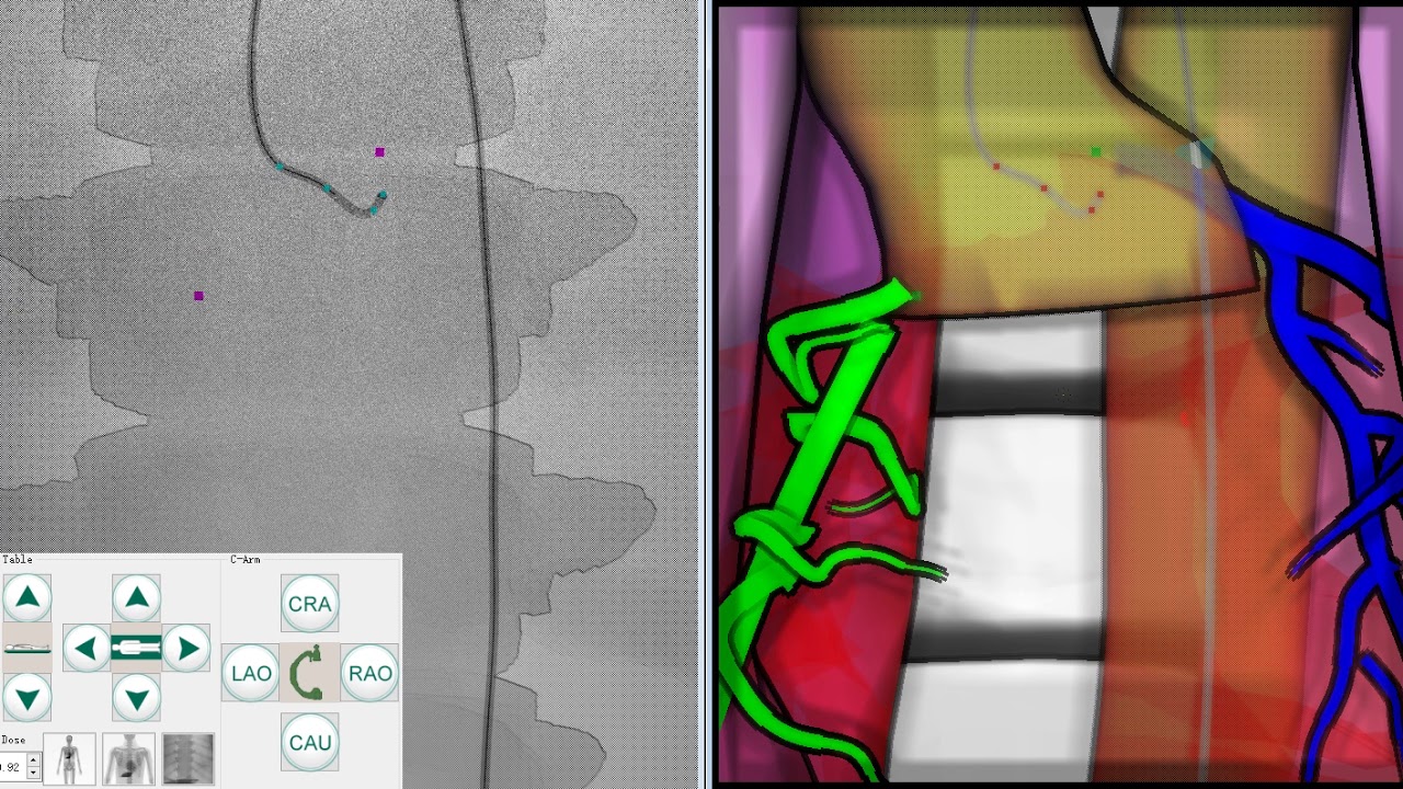 Catheter physical simulation - YouTube