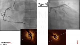 Spontaneous Coronary Artery Dissection (SCAD) Update