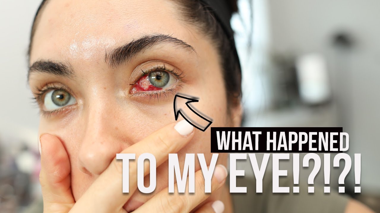 About my pterygium surgery... surfer's eye Melissa Alatorre YouTube