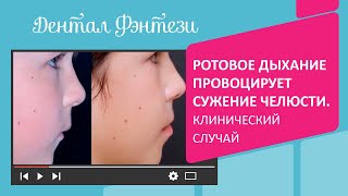 👄  Ротовое дыхание провоцирует сужение челюсти. Клинический случай