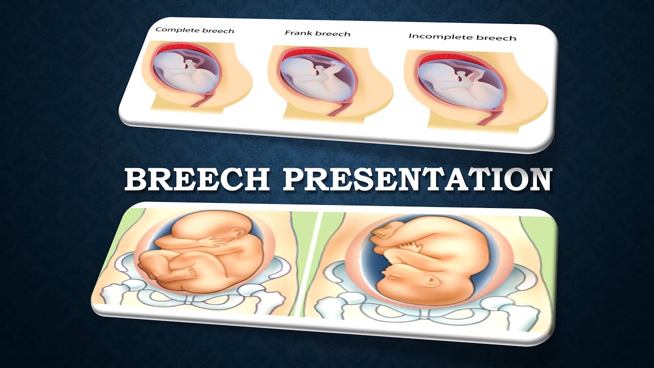 breech presentation in hindi meaning