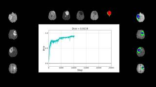 Training a neural network for brain tumor segmentation