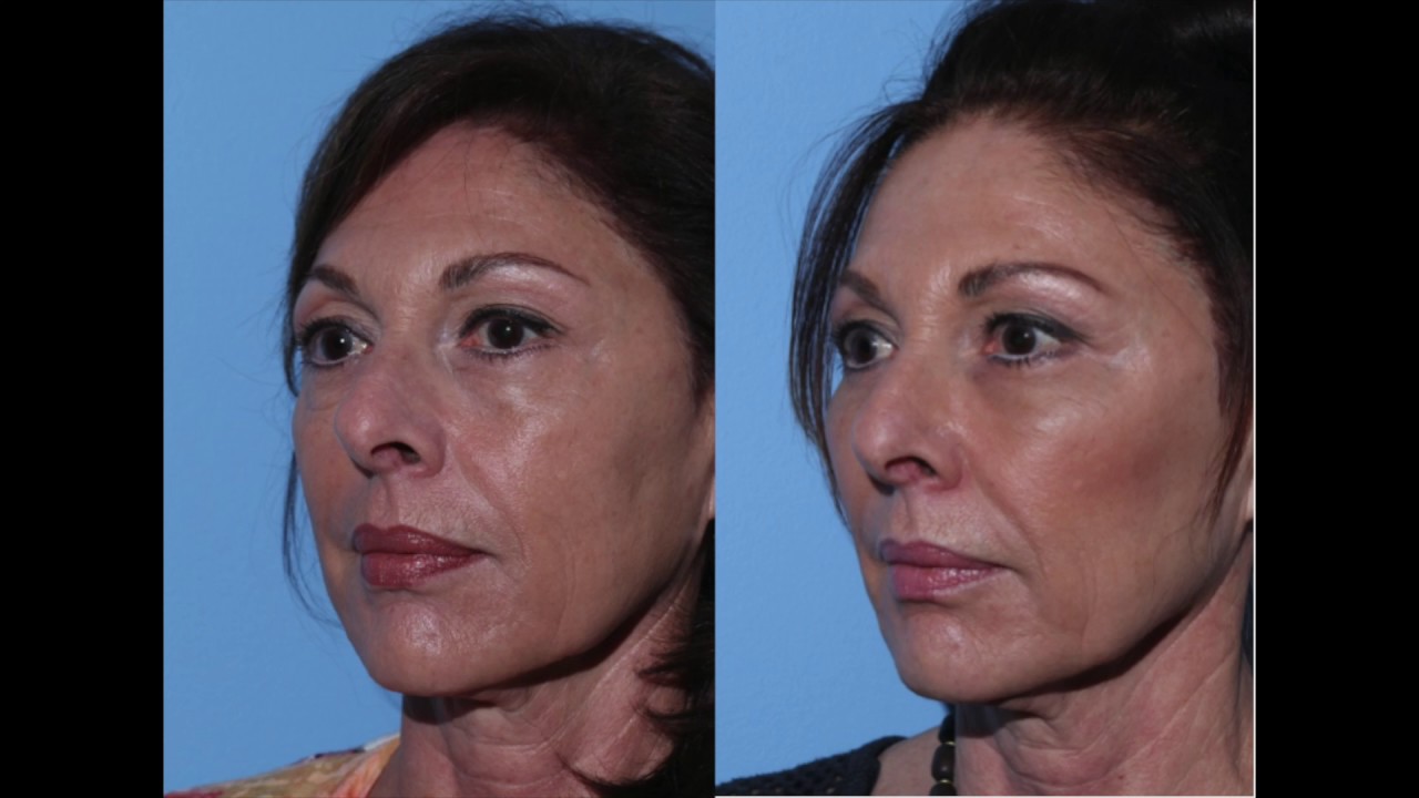 Voluma and Restylane Silk B & A YouTube