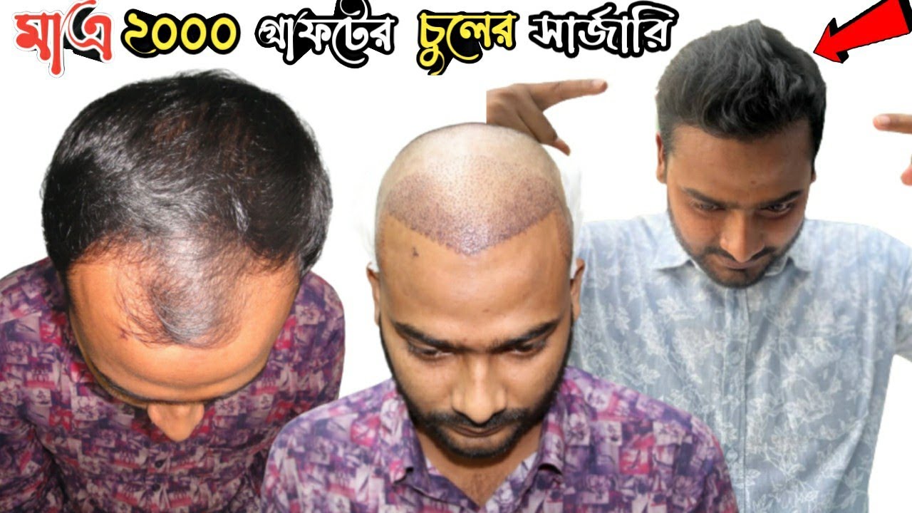 মাএ ২০০০ গ্রাফটের চুলের সার্জারি Hair Transplant Bangladesh Rayhan