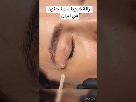 بعد سبعة أيام فقط من عملية شد الجفون في إيران نرى هنا لحظة إزالة الغرز لسيدة بحرينية شدالوجه