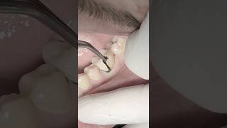 composite restoration after RCT #dentistry