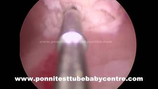Intra Cytoplasmic Sperm Injection Tamil Nadu Icsi India