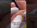 60秒後に魚の目の芯が取れる瞬間映像【用賀フットケア】 #魚の目 #美容 #鶏眼