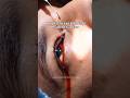 Why is the Eye Bleeding?
