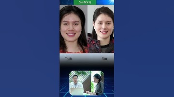 Điều trị lệch mặt với khay niềng răng trong suốt Vinalign  #nambuivinalign  #niengrang #dentist