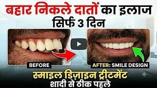 बाहर निकले दांतों का इलाज सिर्फ 3 दिन में! Smile Design Before Marriage|Maharashtra to Dental House 