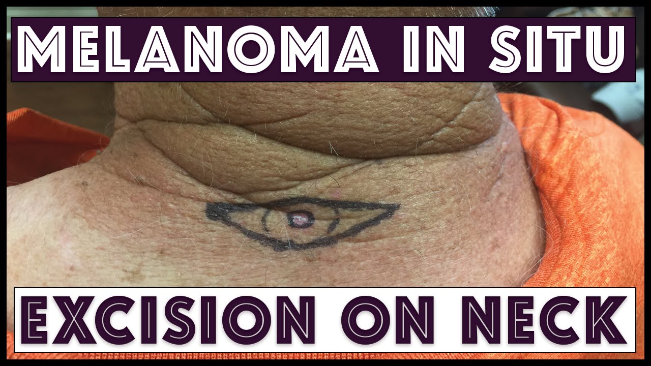 Excision on Neck, Melanoma In Situ YouTube