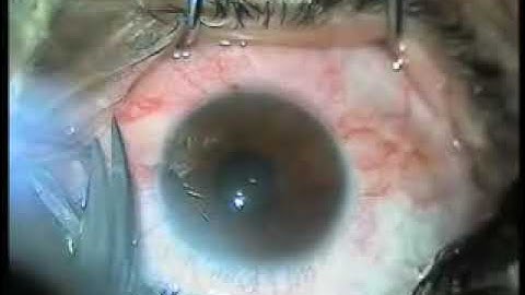 Optic nerve sheath decompression step by step, modified technique step 1 conjunctival incision,
