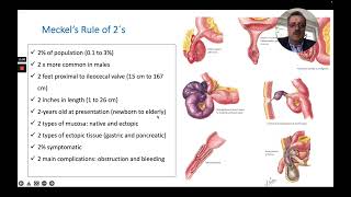 Meckels Rule of 2s