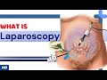 What is laparoscopy