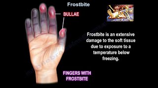 Frostbite - Everything You Need To Know - Dr. Nabil Ebraheim