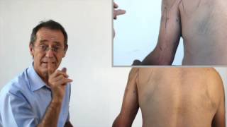 Trigger Point Therapy - Triceps Triggers and Elbow Pain