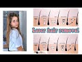 هل ليزر ازالة الشعر فعلا ليه تأثير كل حاجة محتاجة تعرفيها عن الليزر 