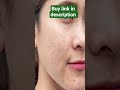 Glyco 6 Cream  | Acne, Dark Spots, Melasma &amp; Tan हटाने में असरदार | Honest Dermat Approved Guide