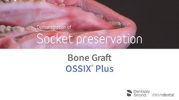 Socket preservation demonstration using Bone Graft & OSSIX® Plus