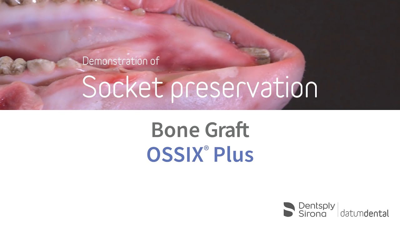 Socket preservation demonstration using Bone Graft & OSSIX® Plus YouTube