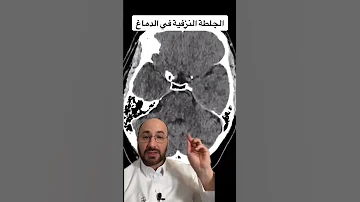الجلطة النزفية داخل الدماغ 