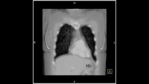 Lung Anatomy: Chest 64 Slice (1 of 5)