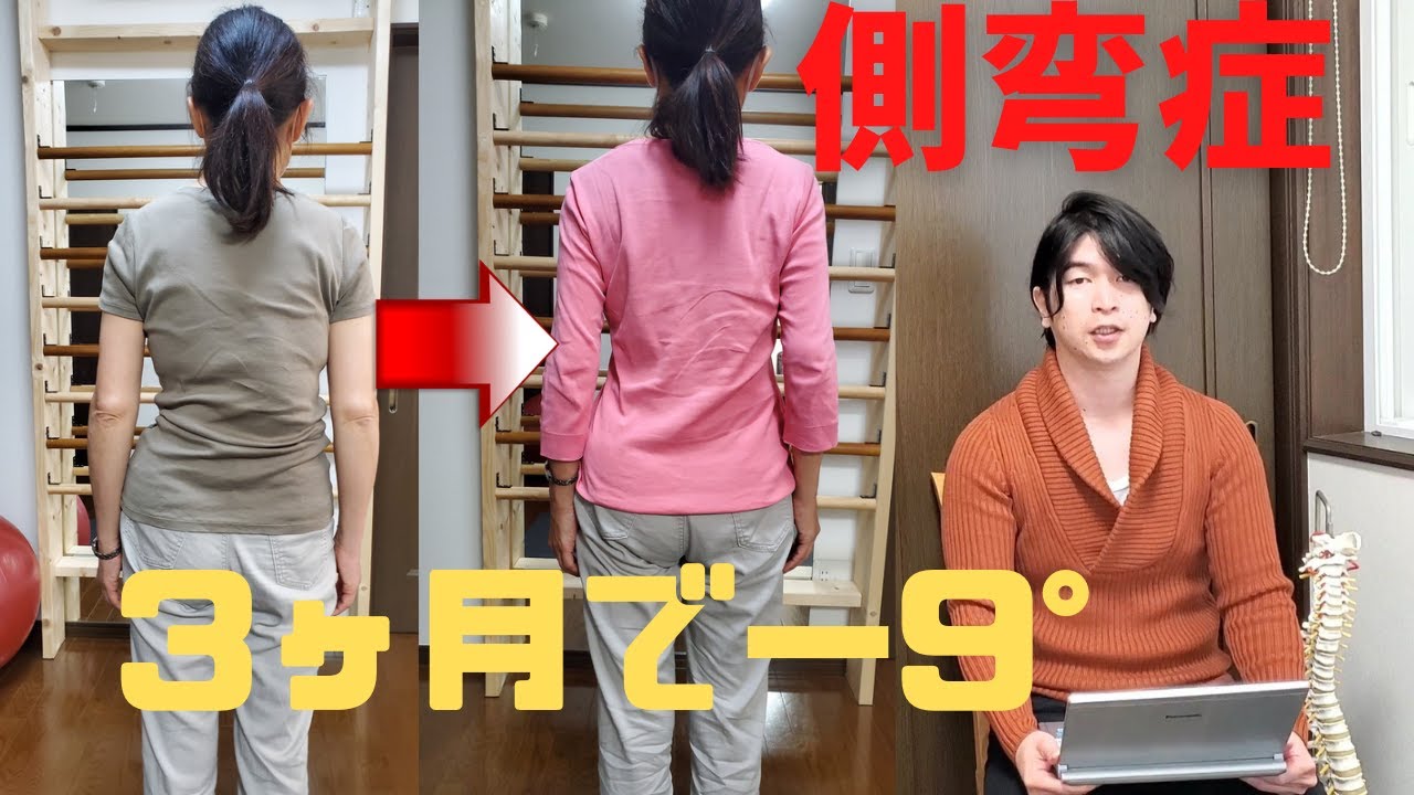 症例報告】側弯症はどのように改善していくのか？ 3か月で－9° - YouTube