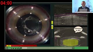 AIOC2024  IC45 Topic  Dr J  S  Titiyal Phacoemulsification in subluxated lens