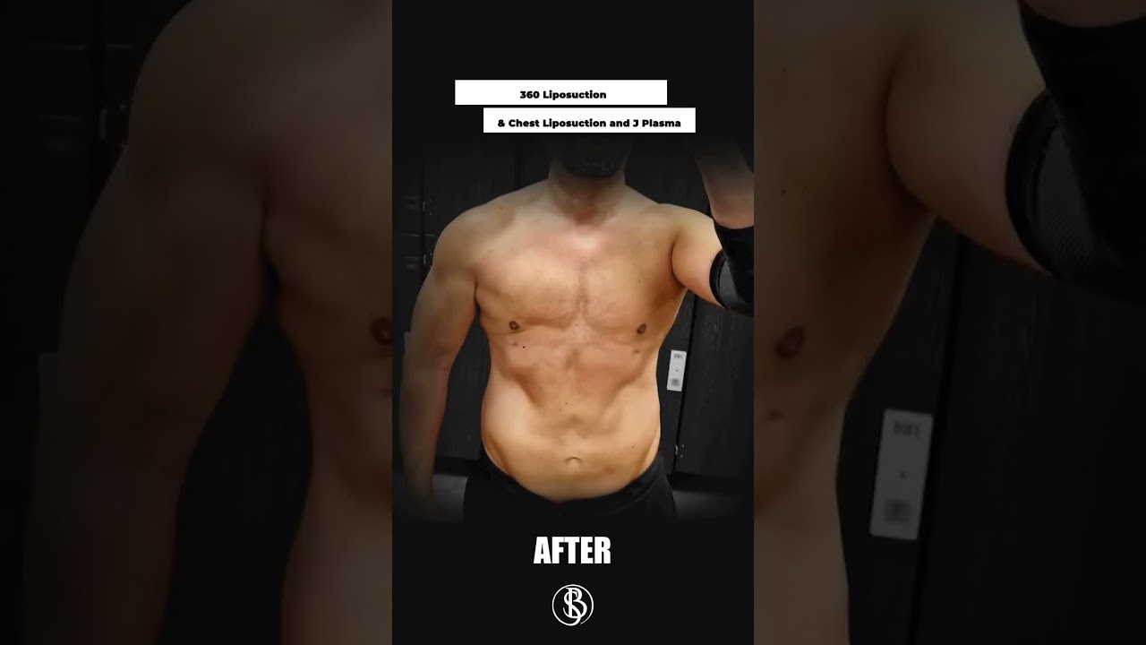 Complete transformation with 360° Liposuction, Chest Liposuction, and J-Plasma! 