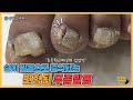 (ENG SUB)발톱 위로 살이 증식되는 무좀발톱!/레푸스 서면점/ingrown toenail/Athlete's foot-Fresh Foot