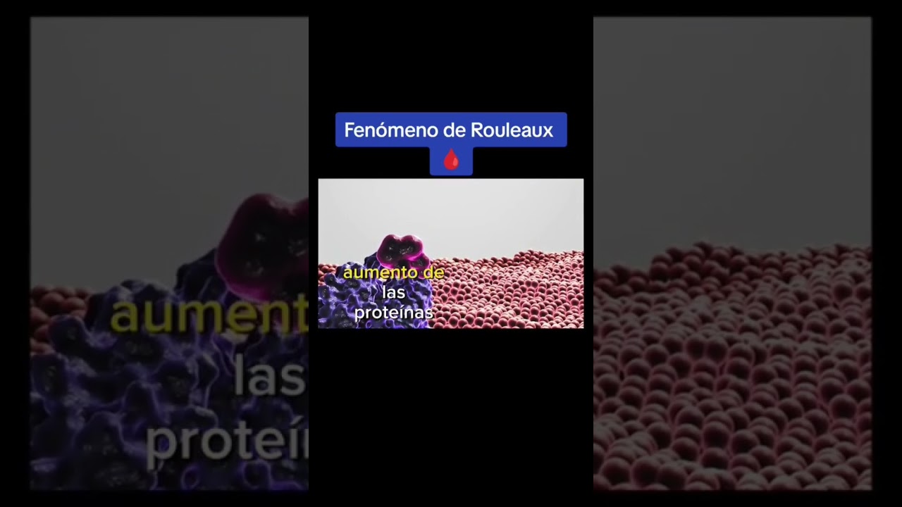 Fenómeno de Rouleaux en él laboratorio clínico