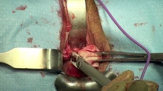 Total Vaginal Hysterectomy (short version)