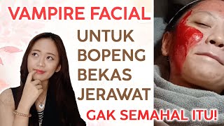 VAMPIRE FACIAL TREATMENT UNTUK BOPENG JERAWAT!!!