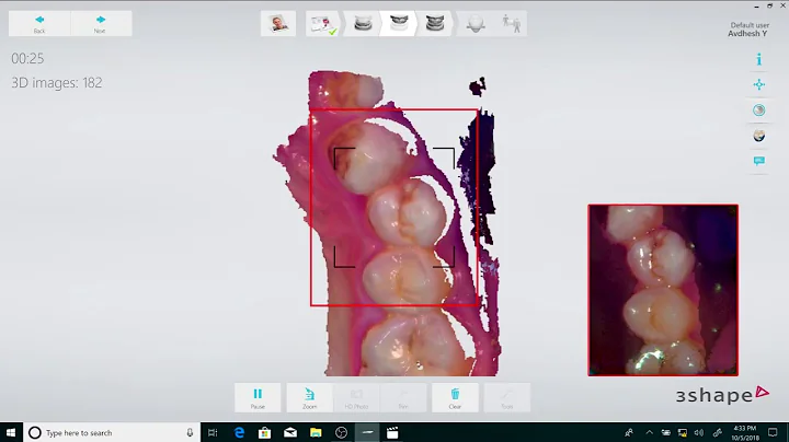 Tips & Tricks for Intra Oral Scanning