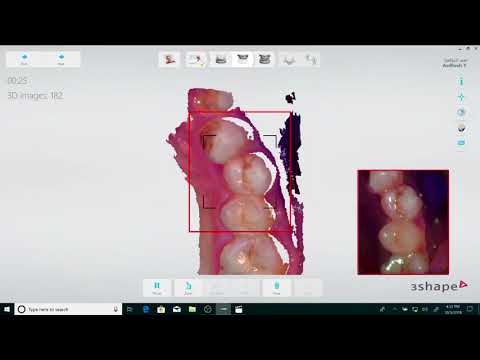 Vidéo: Justesse Et Précision De 5 Scanners Intra-oraux Dans Les Empreintes D'implants Simples Et Multiples: Une étude In Vitro Comparative