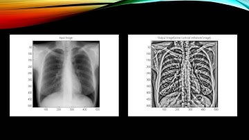 lOCAL CONTRAST ENHANCEMENT CHEST X RAY