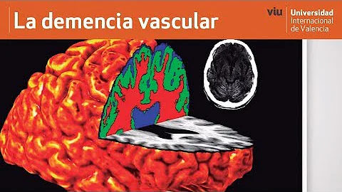 ¿Cómo es la demencia vascular terminal?