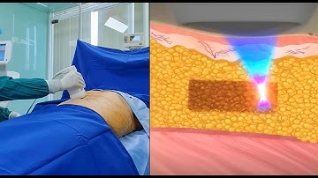 Top 4 công nghệ hút mỡ hàng đầu thế giới đang được áp dụng tại Bệnh viện thẩm mỹ Việt Mỹ