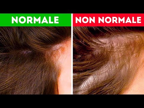 Video: Capelli: Struttura, Cause Di Perdita, Trattamento, Mezzi