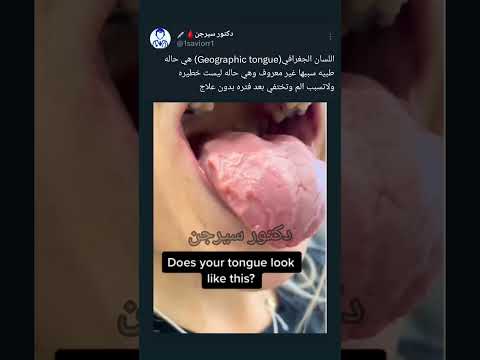 اللسان الجغرافي Geographic Tongue دكتور سيرجن