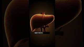 Cirrhosis &amp; Diabetes = End? Nahi. A New Recovery Approach Without Surgery (2026)